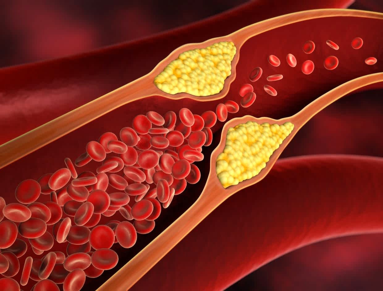 Atherosclerosis