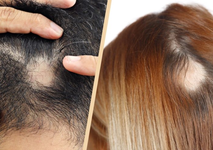 Complex Reasons Behind Hair Loss