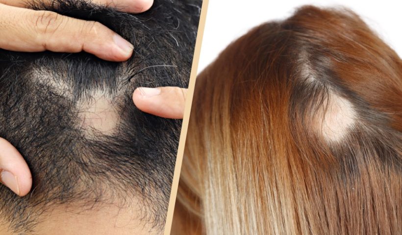 Complex Reasons Behind Hair Loss