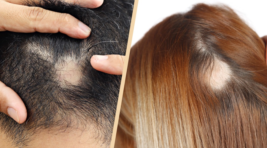 Complex Reasons Behind Hair Loss